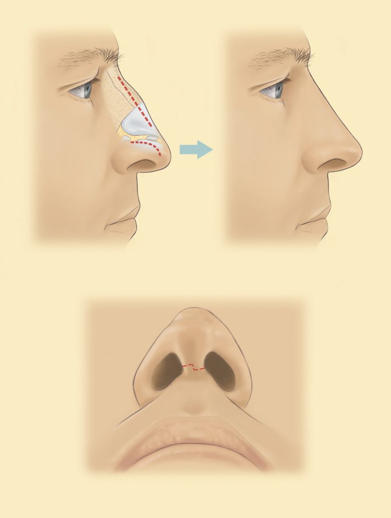 Where are the rhinoplasty incisions placed?